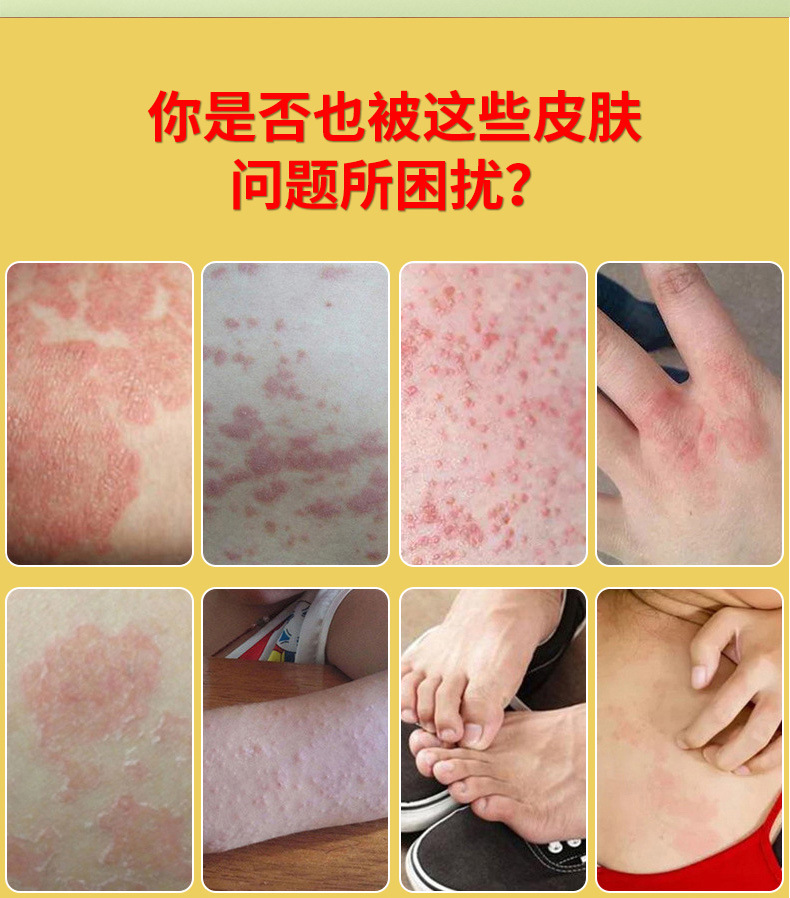 Yao Benren Skin Itch Relief Cream Class II Medical Device 20ml External Use quality and texture