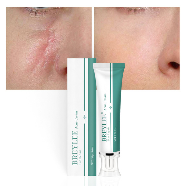 BREYLEE Acne Scar Removal Cream Herbal Gel 30g