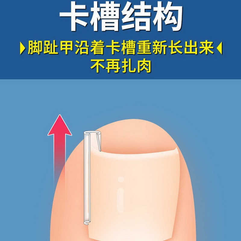 甲溝は甲の矯正器の正甲のパッドを入れて爪を詰めて肉の中に長い隔離パッドを入れて足の爪のパッチ炎を是正します。|undefined