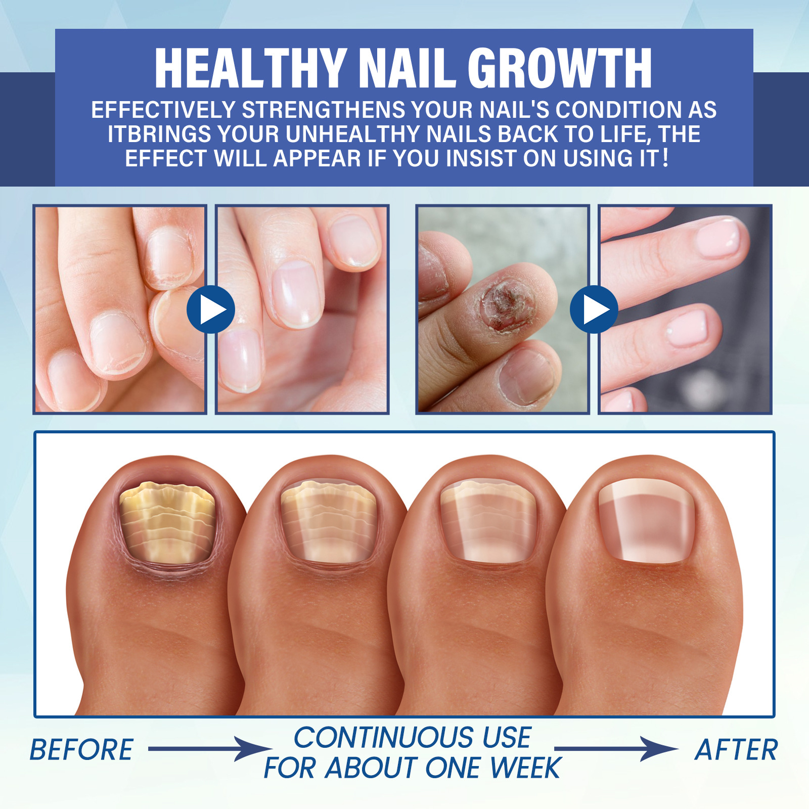Nail Repair LED Phototherapy Instrument - User Experience