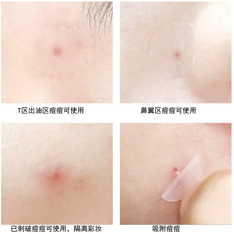 Пластыри от акне Invisible Hydrocolloid Patch, день и ночь, 36 шт.