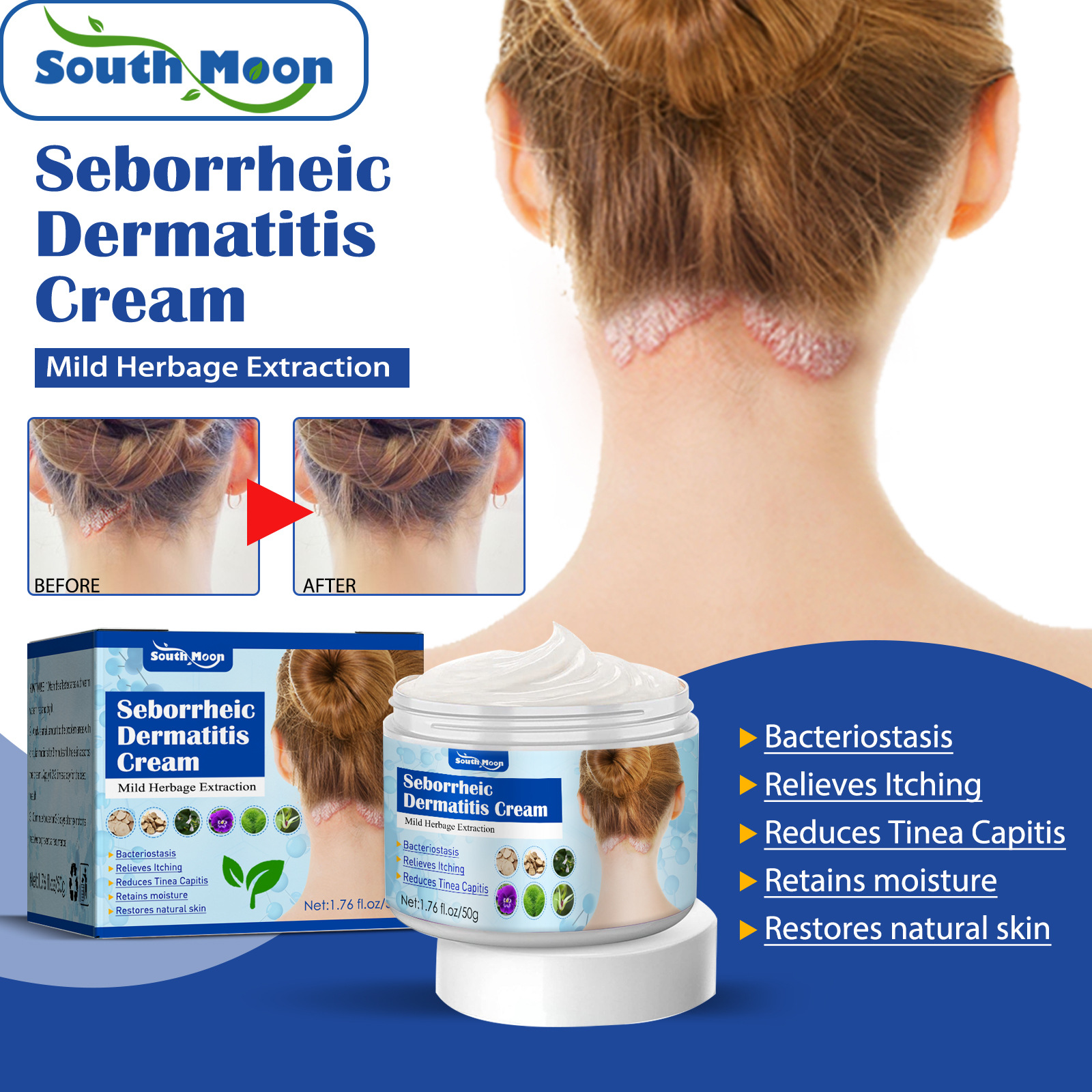 South moon seborrheic skin cream head acne itching scalp ringworm skin problem repair skin cream_voghion.com