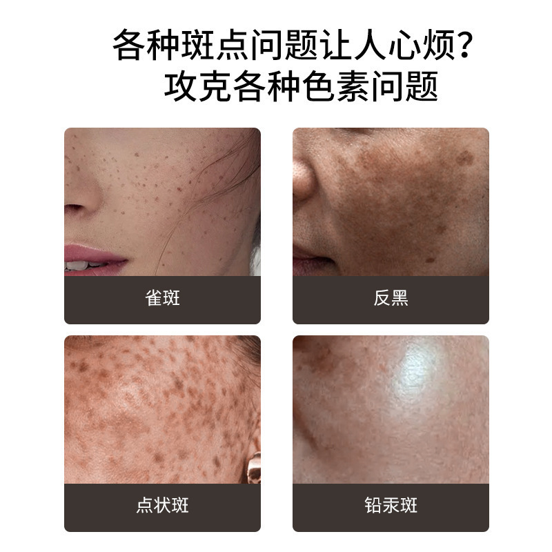 美白コントロールクリーム美容院のシミの後で色をコントロールしてシミを取り除きます。|undefined