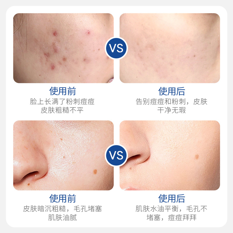 Imagen belleza hidratante refrescante anti-Acné limpiador facial hidratante limpieza limpiador facial mejora la piel seca productos para el cuidado al por mayor