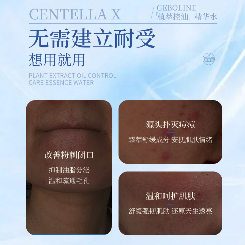 歌宝莲闭口水青少年控油痘清爽肤水缩毛孔精华水男孩女孩湿敷水|undefined