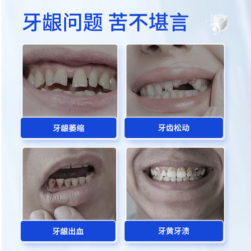 Dental separation agent, gum recession, loose teeth, consolidation, periodontal care, cleaning and separating toothpaste, factory wholesale