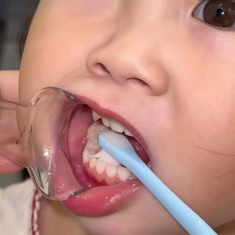 Oral C-type mouth opener, dental mouth stretcher, orthodontic tool for taking photos of dental veneers, transparent mouth opening device