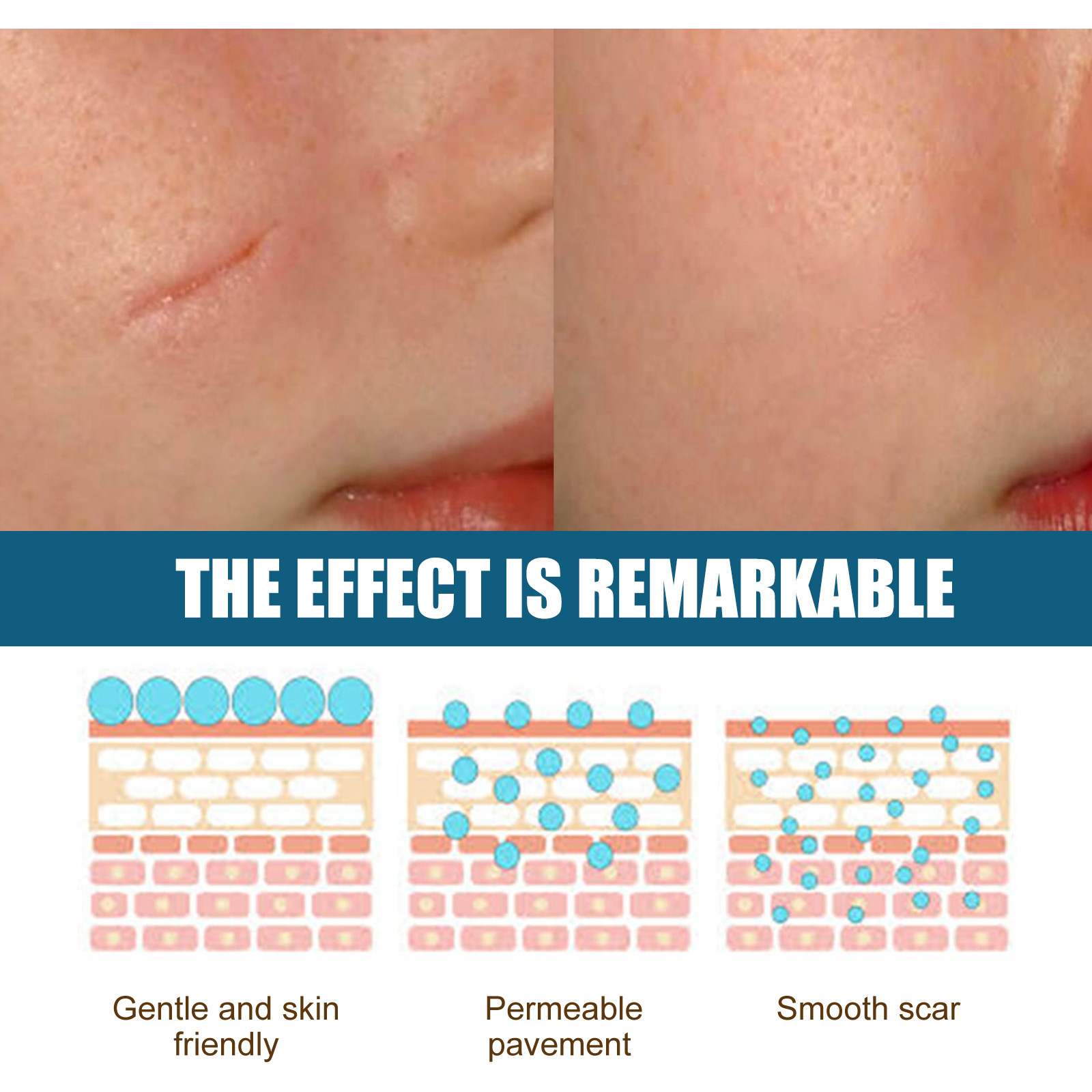 EELHOE Essence de réparation de cicatrices, estompe les cicatrices chirurgicales, essence de réparation de cicatrice de césarienne, lisse et hydrate la peau, (paquet de 3)_voghion.com