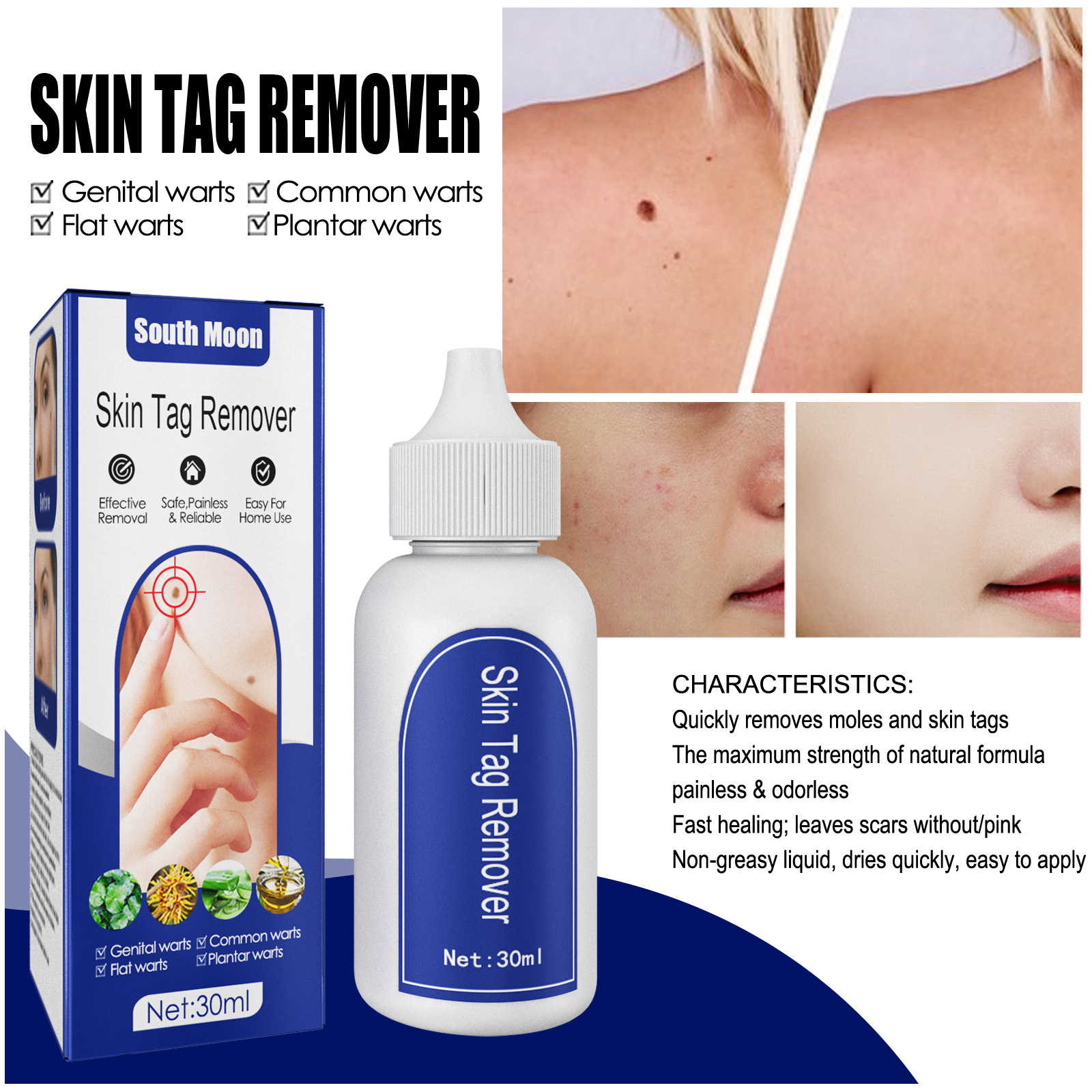 South moon warts must be removed to remove warts acuminate warts, flat warts, thorn warts, remove filamentous warts, herbal anti-wart liquid_voghion.com