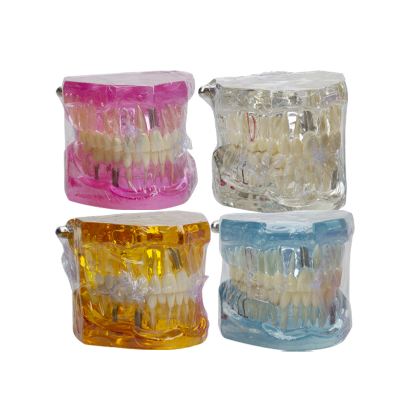 Modelo de implante dental, modelo dental patológico, modelo oral desmontable, modelo de explicación de puente, protección dental