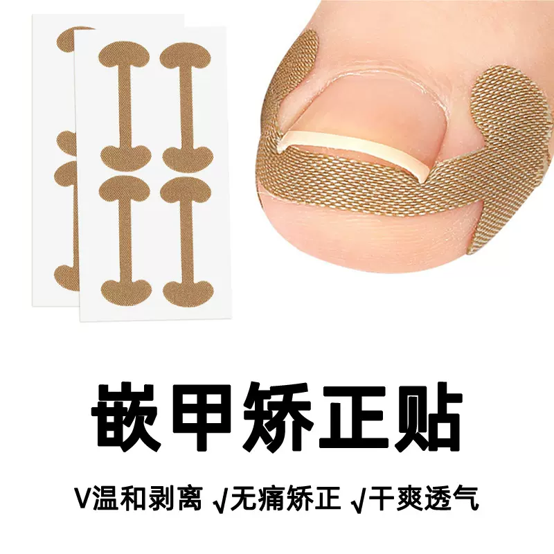 脚指甲甲沟嵌甲足甲矫正器拇指卷甲贴片快速修脚趾甲变形肉包