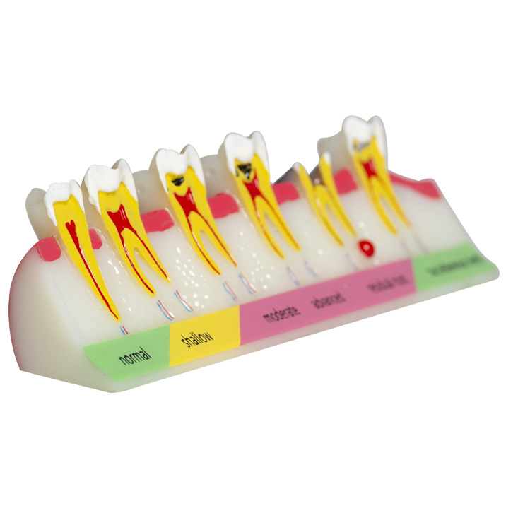 Modelo dental molde modelo dental modelo de enseñanza dental removible dentadura oral cepillado Preparación del diente modelo resina