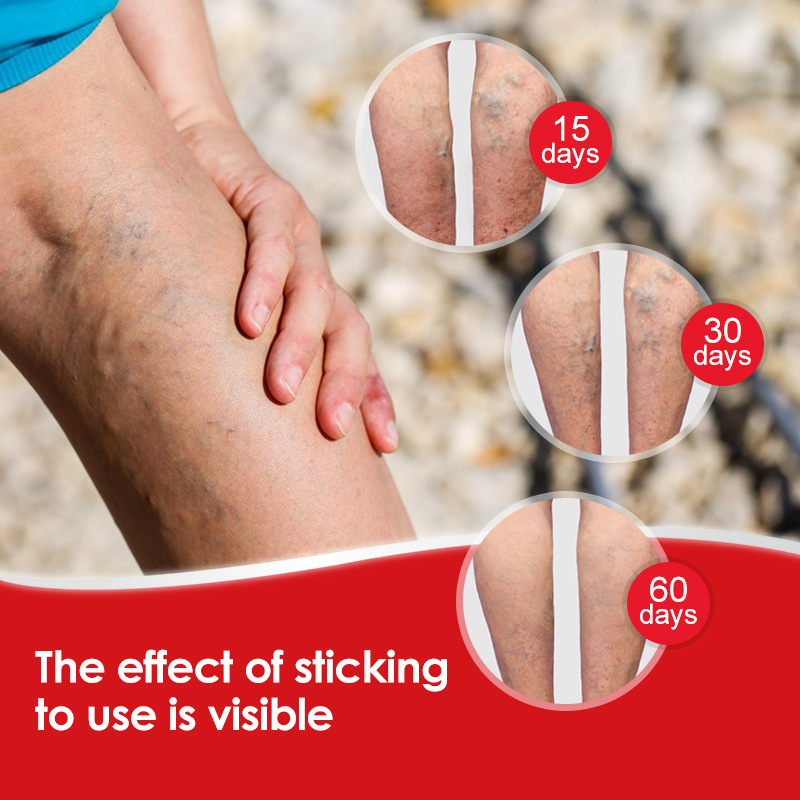 Sumifun Amazon Ungüento transfronterizo Ungüento intravenoso Ungüento Maikang Ungüento Mai Lishu Ungüento vascular de pierna de lombriz de tierra