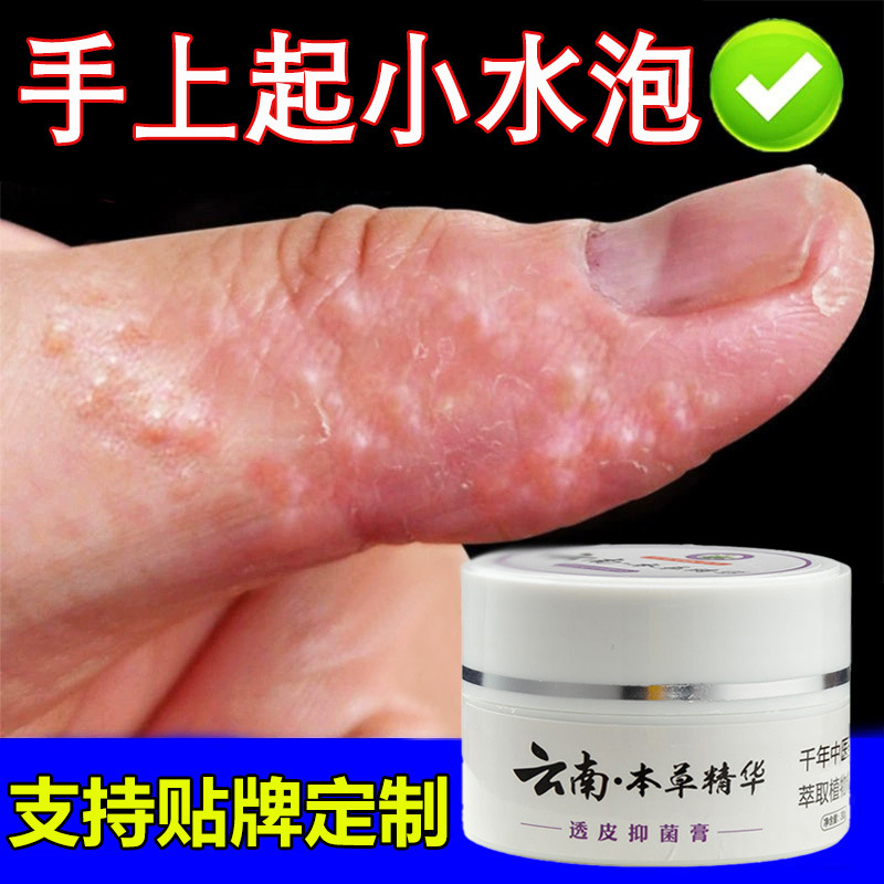 Yunnan Materia Medica Antibacterial Cream Small Blisters on Hands Ointment Sweat Blisters Diagnosis Desquellation Black Skin Antipruritic Five Products Yunnan Materia Medica Antibacterial Cream Small Blisters on Hands Ointment Sweat Blisters Diagnosis Desquellation Black Skin Antipruritic Five Products