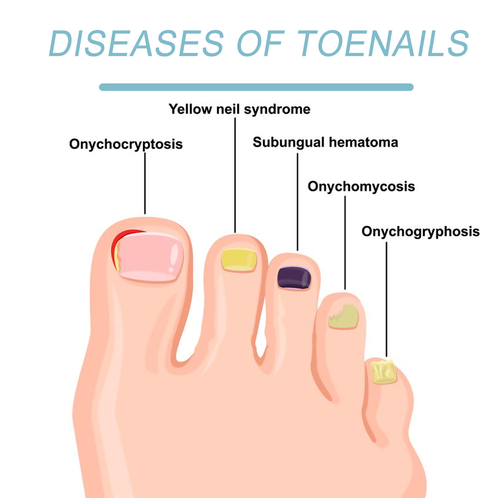 Elegant Design of Nail Treatment Device