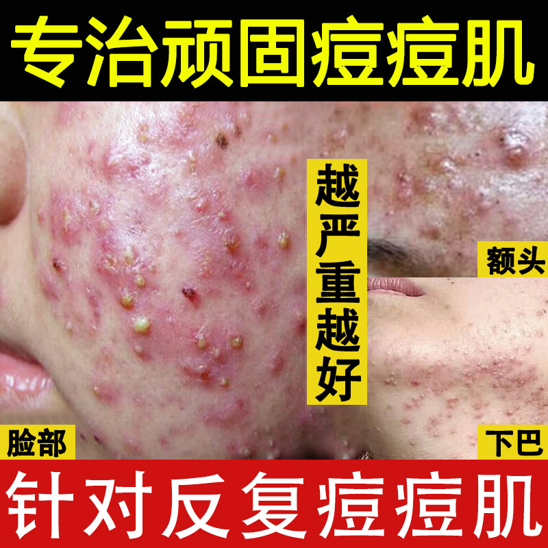 草本祛痘膏淡化痘印祛痘精华液去粉刺闭口修复痤疮痘印青春痘面霜