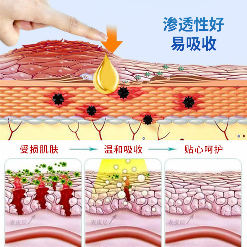 乾癬専用軟膏 乾癬を緩和するクリーム 肌の痒みや不快感を修復し、かゆみを和らげる乾癬専用軟膏|undefined