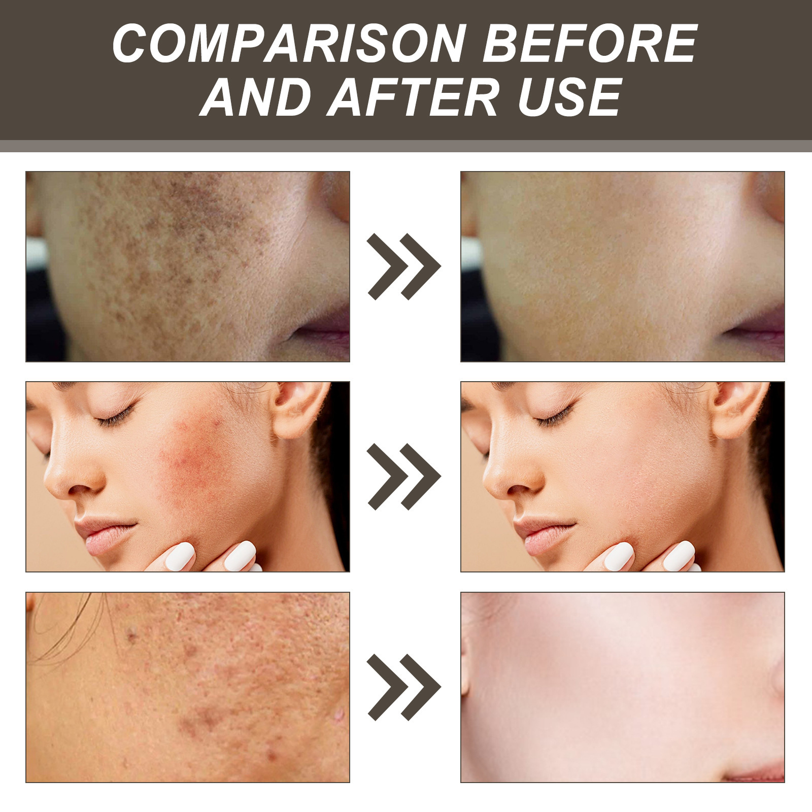 Plasture anti-iritații West&Month pentru a atenua roșeața, petele acneice, defectele gurii închise, acoperirea petelor, plasturi reparatori_voghion.com