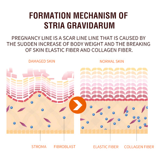 Jaysuing Pregnancy Repair Spray Fades Pregnancy Fine Marks for Pregnant Women and Postpartum Skin Stretch Marks Care Spray