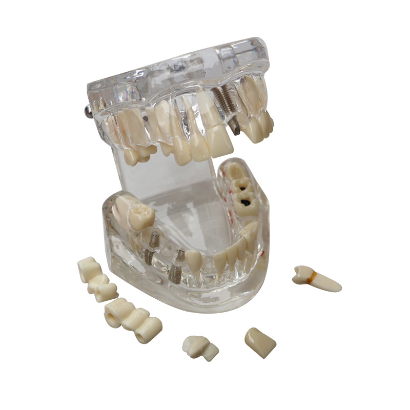 Herramienta de enseñanza de modelos dentales para la comunicación entre paciente y médico, molde dental transparente, modelo de explicación de implantes extraíble para niños.
