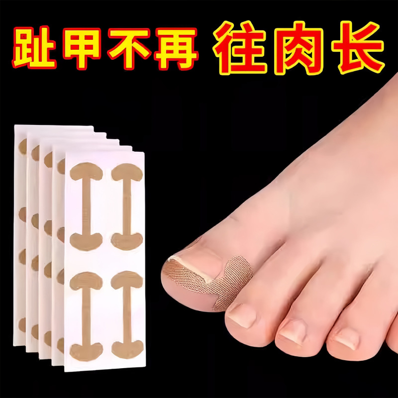指甲矫正贴正甲贴指甲矫正器脚趾甲长肉里填充垫片纠正炎嵌甲拉贴|undefined