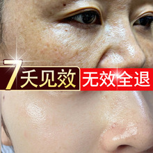 祛斑霜美白去黑色素源头去老年斑黄褐斑晒斑淡斑美容院专用炸斑霜