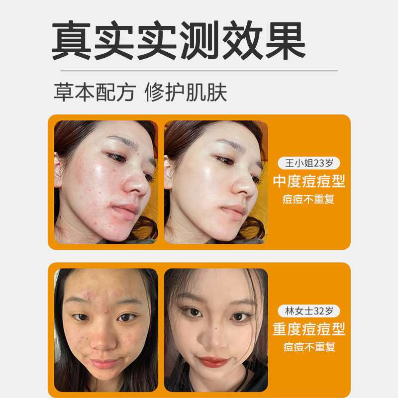 ニキビ除去クリーム、ニキビ跡を薄くする、ニキビ閉鎖修復因子、オイルコントロール、毛穴縮小、高保湿、美白クリーム|undefined