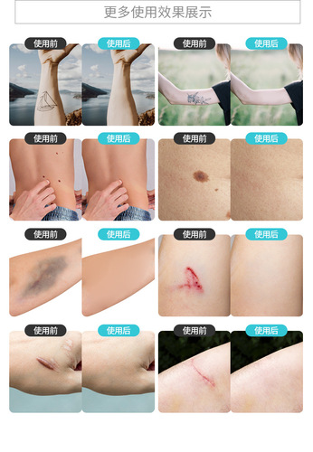 Professional Tattoo Covering Sticker Large Area Neck Birthmark Scar Concealer Waterproof Long-lasting Invisible Patch for Women's Indented Scars