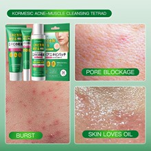 跨境祛痘霜 Anti Acne Cream去黑头粉刺痘痘淡化痘印积雪草祛痘膏