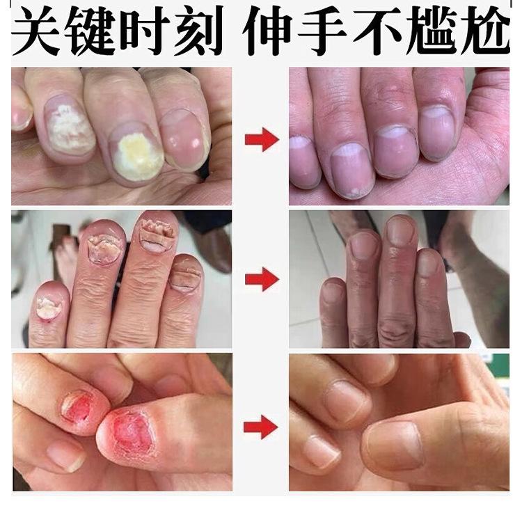 香港薬局爪真菌症液体栄養液抗菌液体爪真菌症修復液体 Douyin フットケアドロップシッピング|undefined