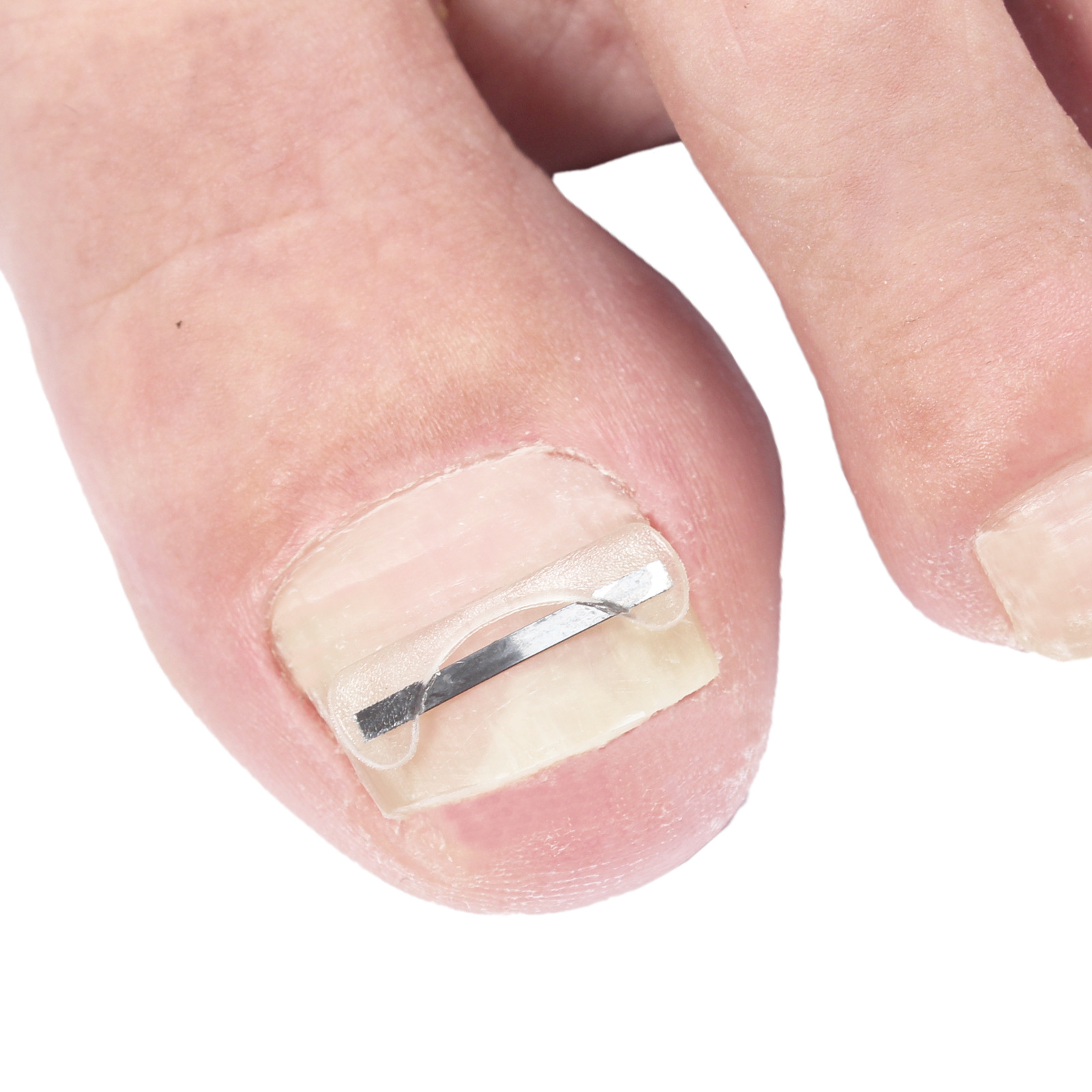 Parche de ortograna de aleación de titanio de quinta generación Parche de memoria elástica de hueso biónico Cortesis de alambre de ortograna