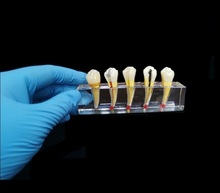 牙科口腔教學模型蛀牙齲壞發展演示水晶根管成人病理模型牙齒展示