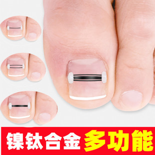Nickel titanium alloy nail groove embedded nail steel wire corrector nail patch toenail nail pricking inflammation corrector