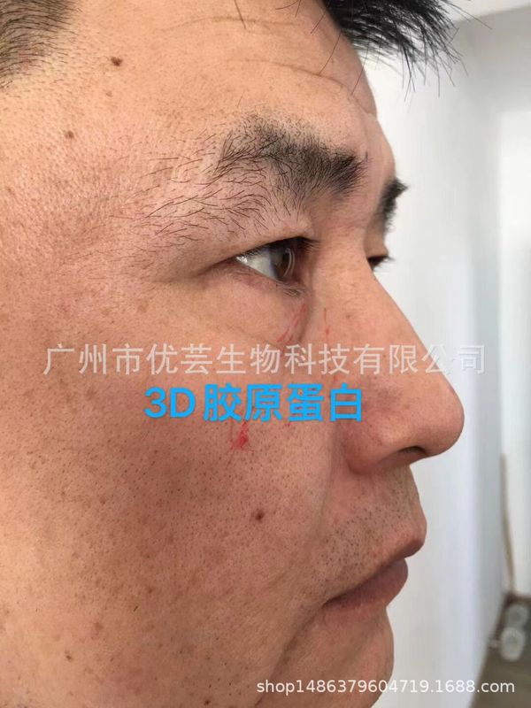 3D 3 タイプ コラーゲン 10 万単位で涙溝と額を活性化し、工場から直接供給して操作できます。|undefined
