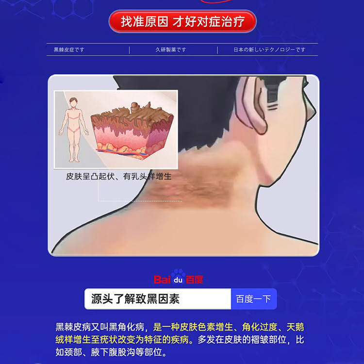 首のメラニン沈着を除去し、首のメラニンを除去し、太りすぎや黒ずみを除去する黒い棘皮症軟膏を長期間開発|undefined