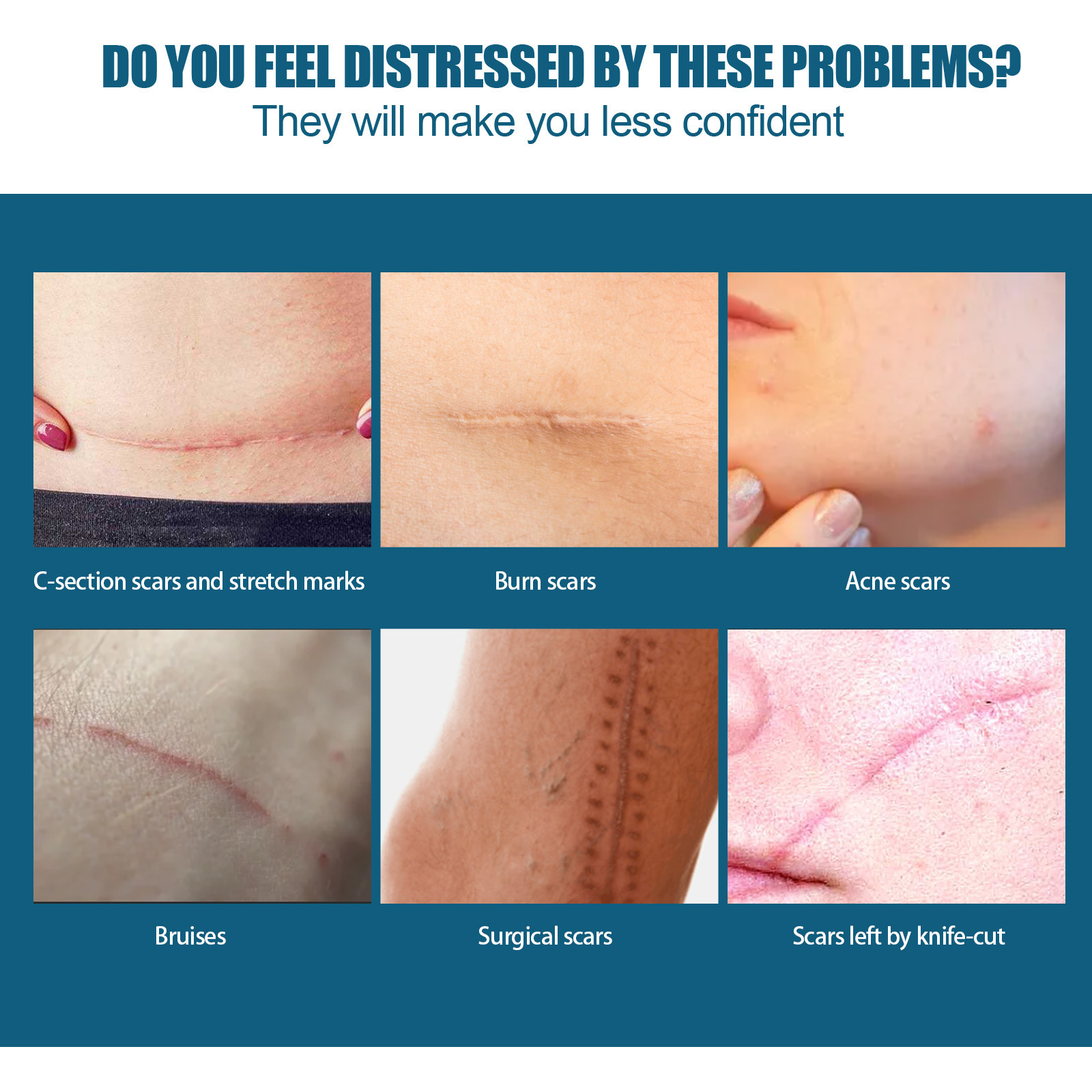 EELHOE Essence de réparation de cicatrices, estompe les cicatrices chirurgicales, essence de réparation de cicatrice de césarienne, lisse et hydrate la peau, (paquet de 3)_voghion.com