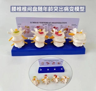 Four classification lumbar spine normal and lumbar spine and lesion combination model human skeleton model skeleton medical teaching