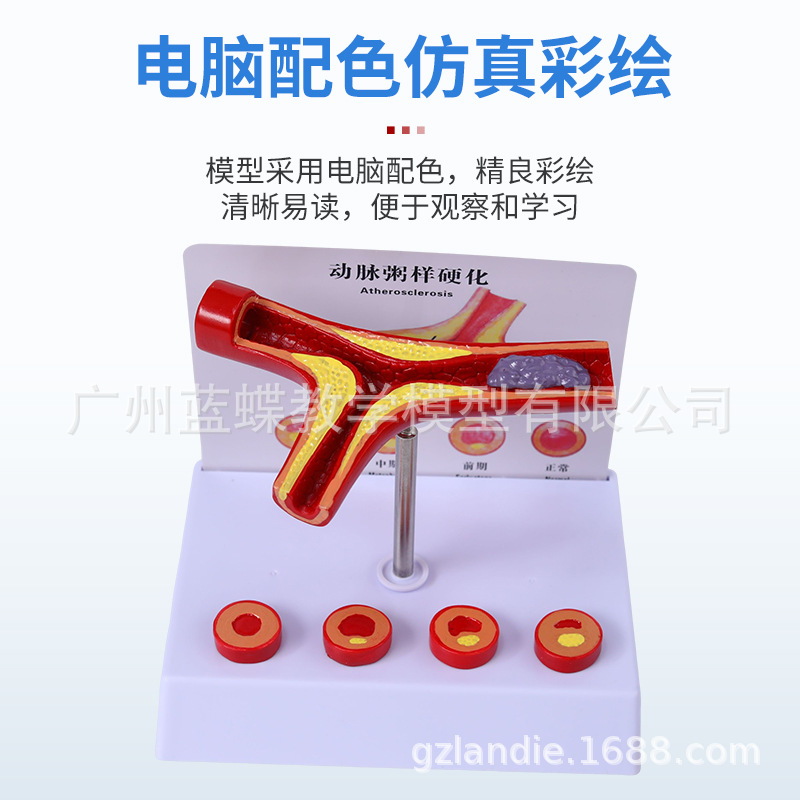 Ѫ�ܷ������Ѫ֬��Ѫ֬ģ�Ͳ�����̬Ӳ������Ѫ˨ֱ�۽�ѧ����