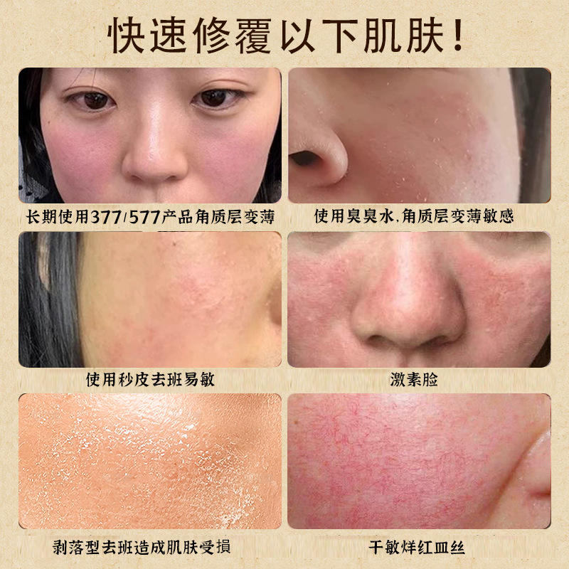 术后修复霜抗炎敏感肌增厚退红补水保湿敏感院线退红面霜舒缓肌肤|undefined