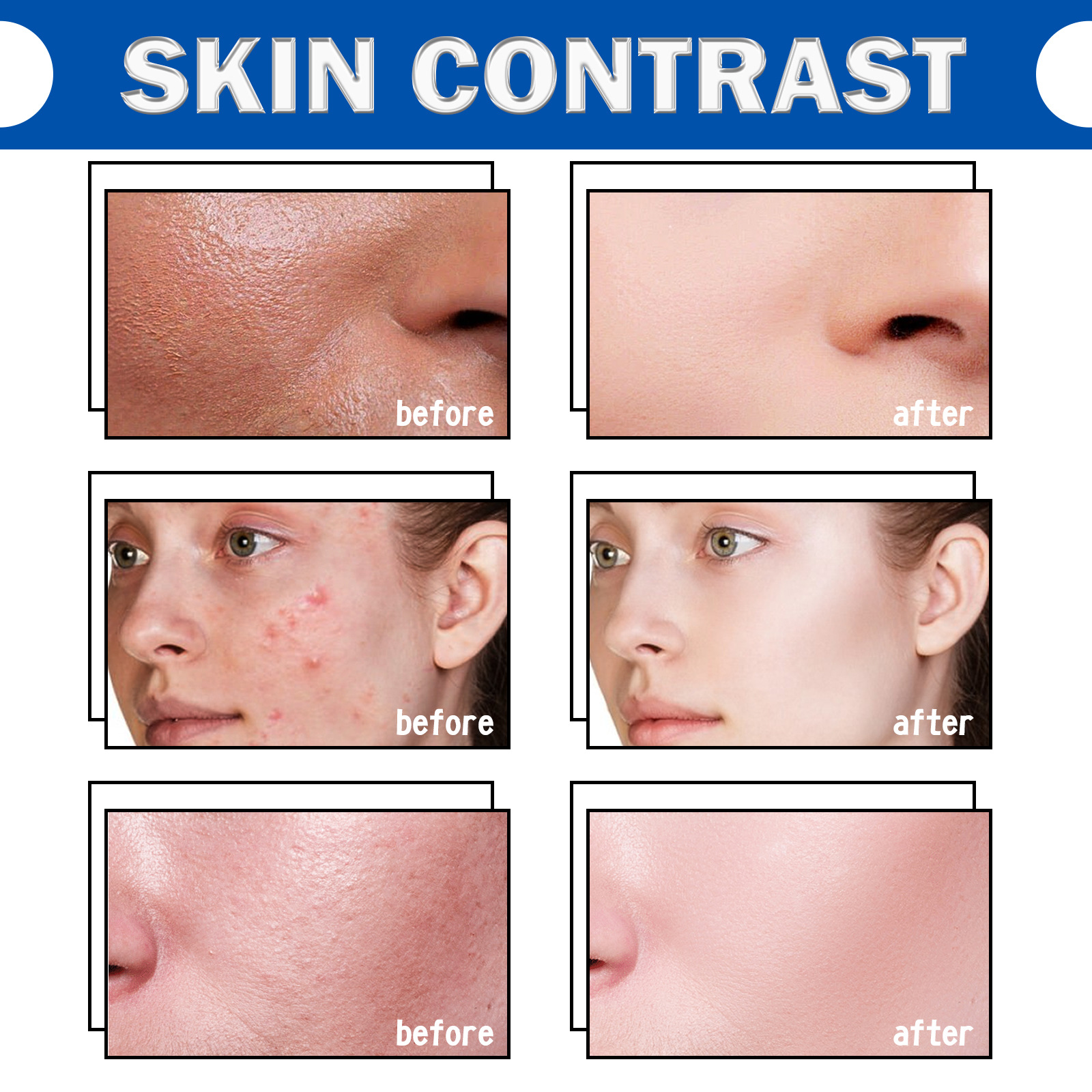 EELHOE Small Blue Bottle Removing essence Liquid Lightens Acne Marks, Firms Pores, Mildly Moisturizes and_voghion.com