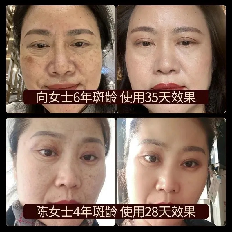 熊果配糖体はぶちを取り除きます。美容院の美白は薄いぶちを取り除きます。|undefined