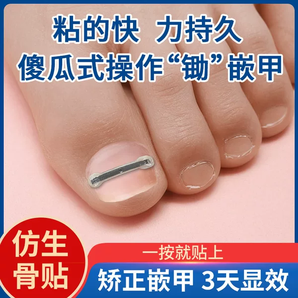 Jiagou nail inlaid steel wire nickel-titanium alloy bionic bone patch nail nail nail nail prick inflammation corrector