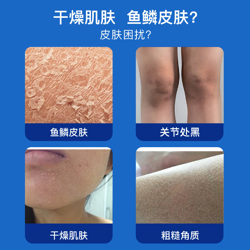 Zhenxi ビタミン A 酸クリーム、鶏皮除去尿素クリーム、ニキビ跡除去軟膏、メラニン除去クリーム卸売|undefined