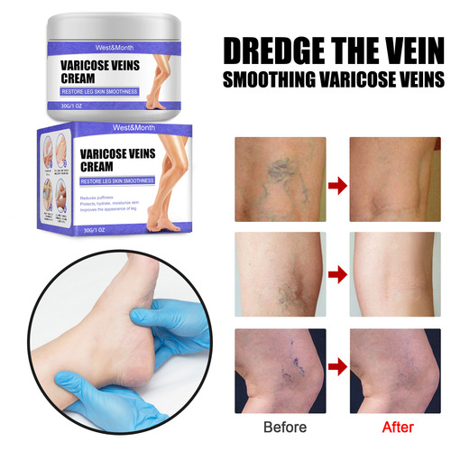 Vein repair cream, leg varicose veins, bulging leg veins, pain, Maikang leg care vein cream
