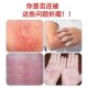 Wholesale genuine goods sweat blister ointment plaster for men's and women's skin external use stubborn itching sweat blister special plaster a batch