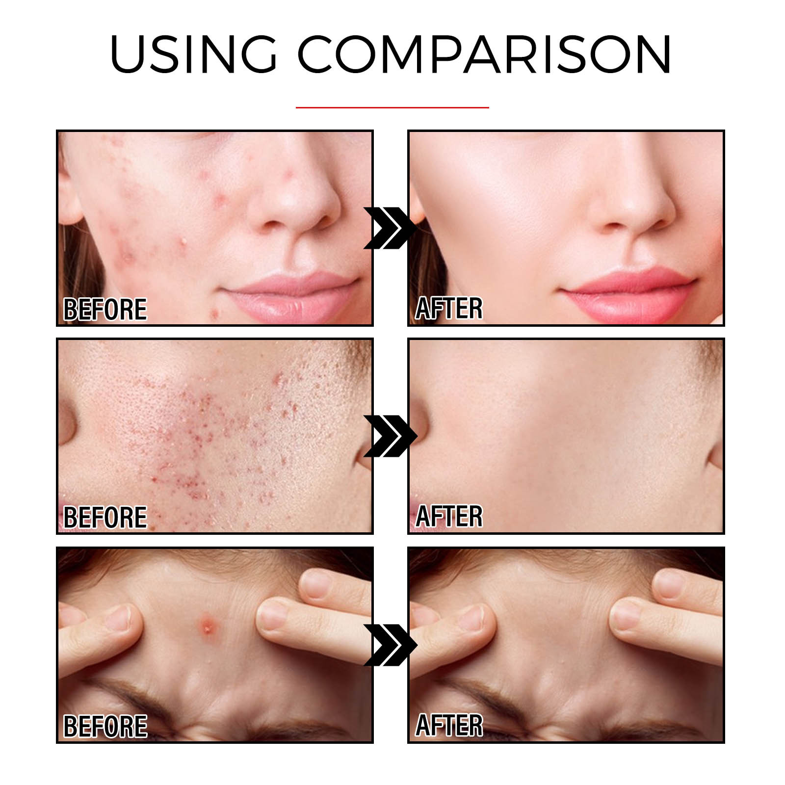OUHOE Reparatie Gezichtsbedekking Verzachtende Huidverzorging Acne Patch_voghion.com