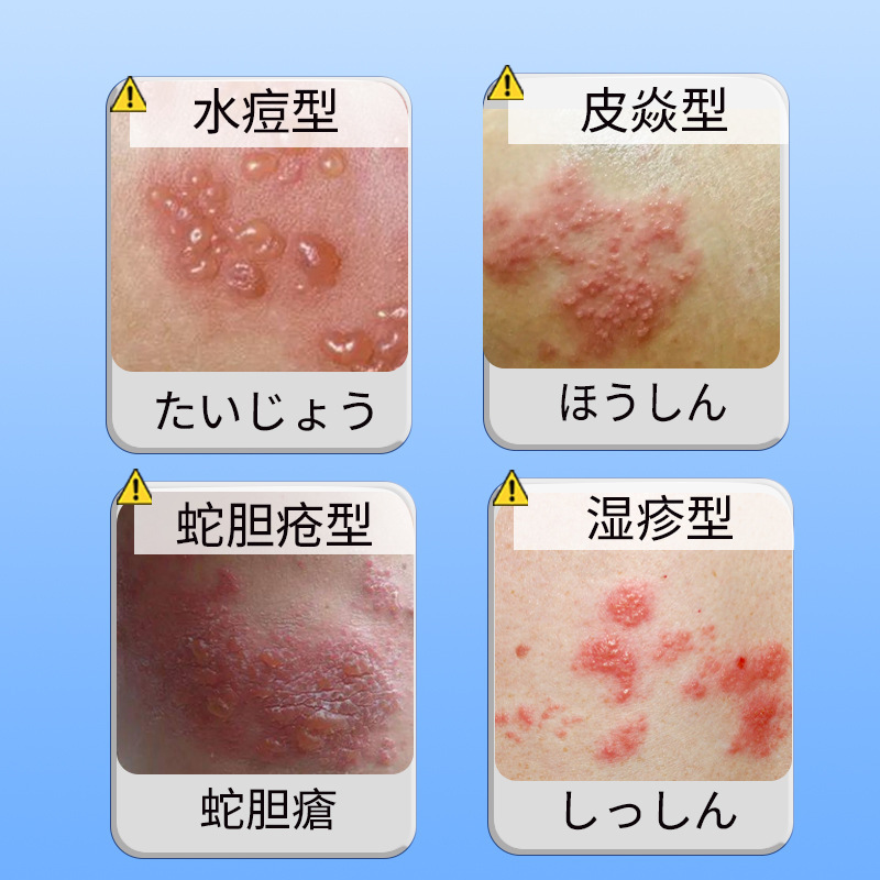带状疱泡疹蛇盘后遗症神经外用膏蛇缠腰止痒瞬时康腰上水痘贴膏|undefined