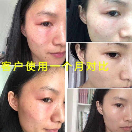 Hormone face repair cream repairs sensitive redness, desensitizes and removes acne marks beauty salon sensitive skin moisturizing repair cream