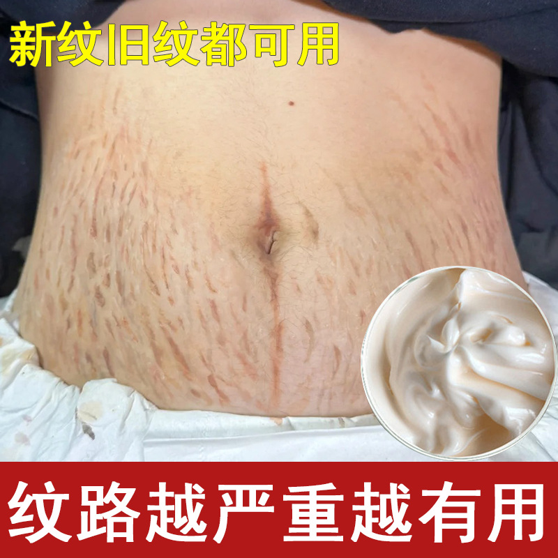 妊娠纹修复霜产后去孕纹淡化肥胖纹淡纹身体乳美容院官方正品批发