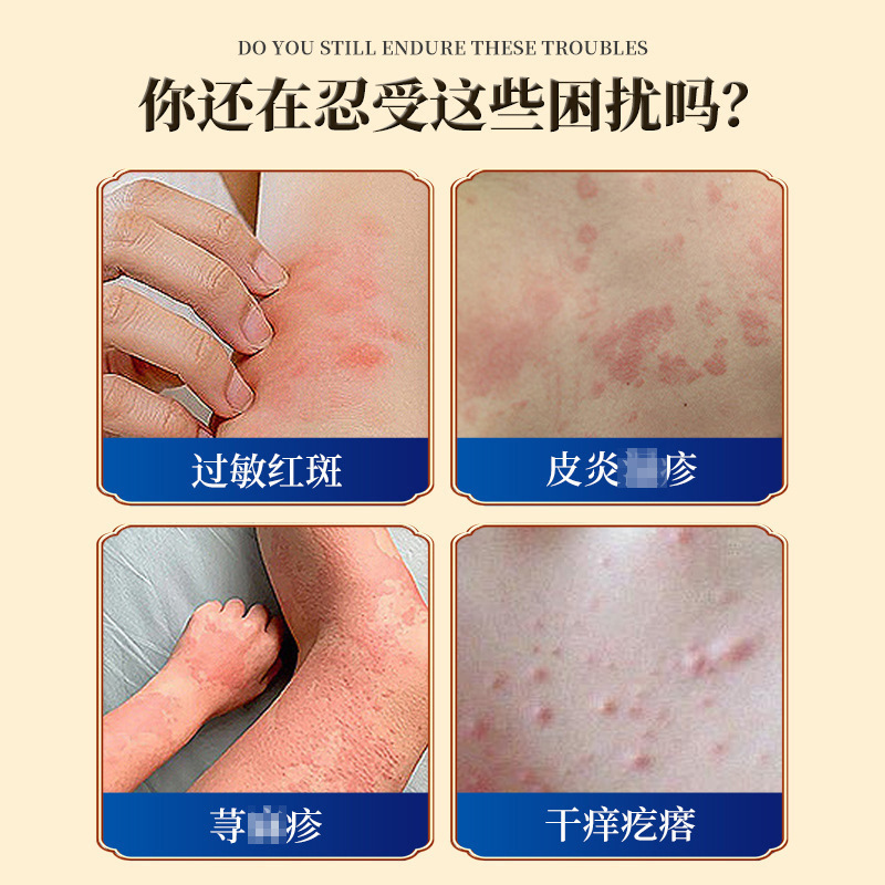 疹膏皮炎皮癣止痒膏过敏红斑护理膏汗疱荨麻 疹皮肤瘙痒修护霜|undefined